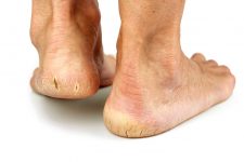 Cracked heels on white background. Copy space