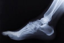 X-Ray