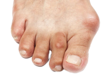 bunions