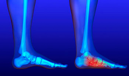 flat-feet