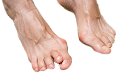 hammertoe