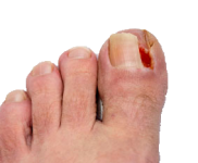 ingrown-toenail