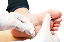 warts